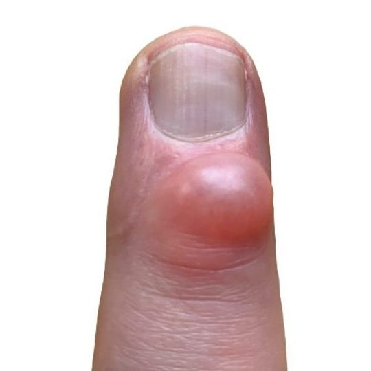 Ganglion & Mucoid Cysts: What They Are and How to Manage Them