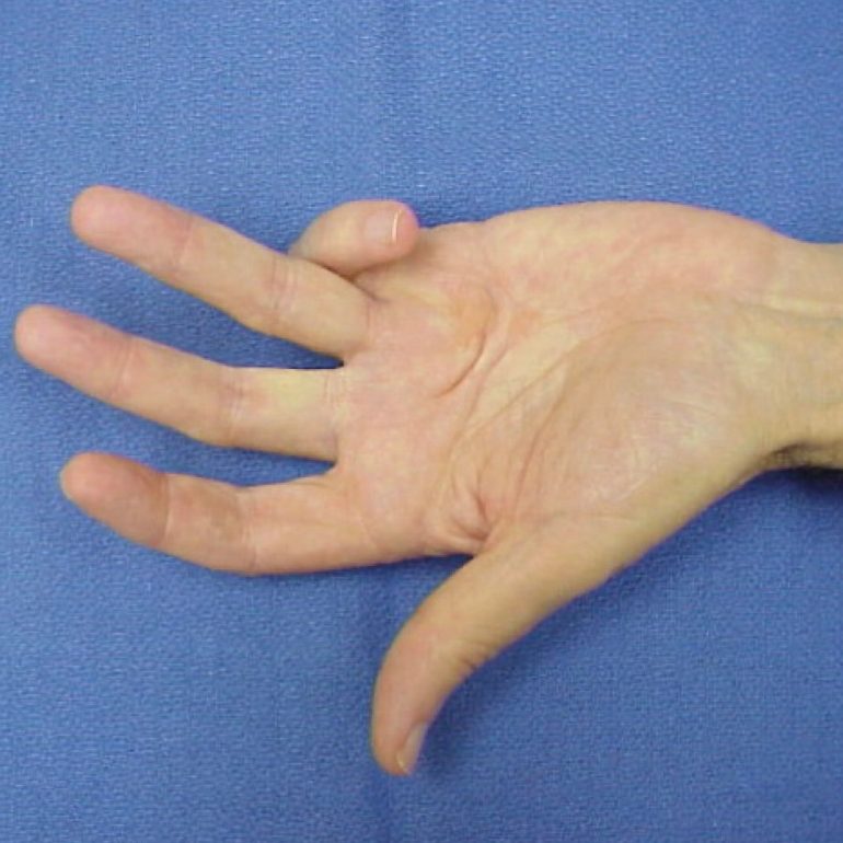 Dupuytren’s contracture treatment Gold Coast, Needle aponeurotomy specialist, Hand condition and finger stiffness treatment, Collagenase injection for finger contracture