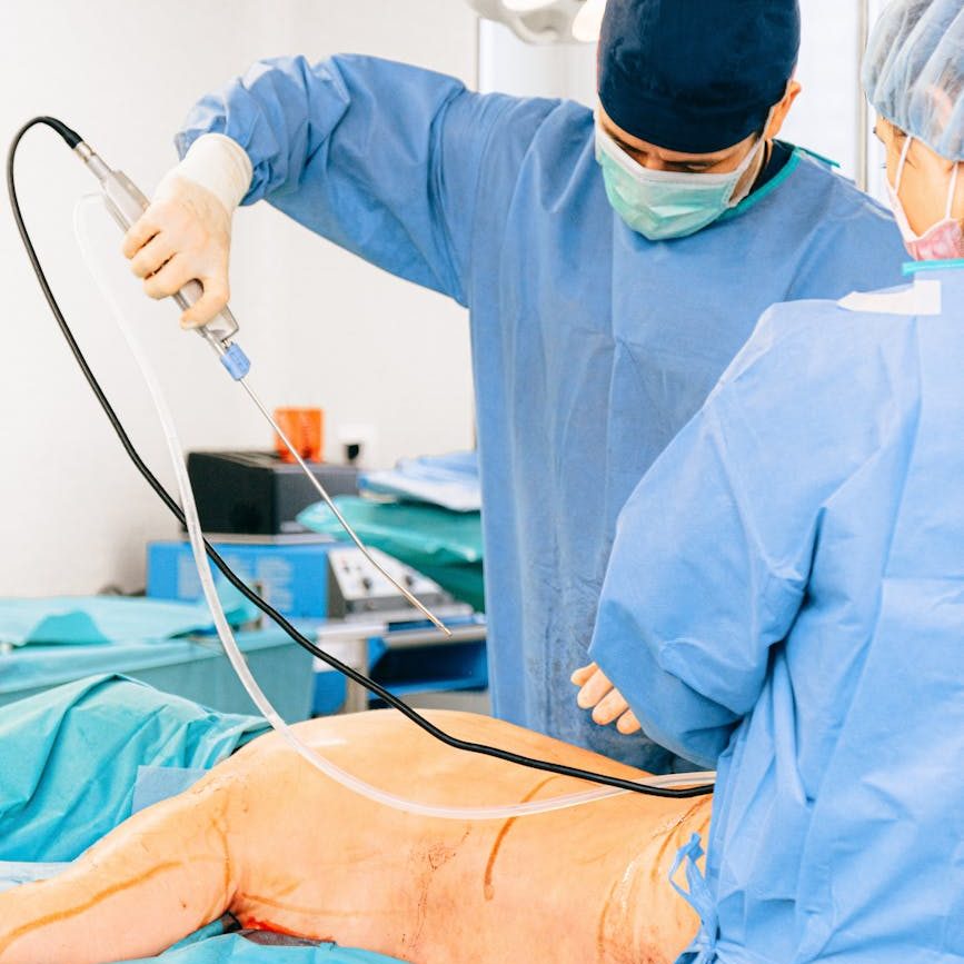 Liposuction: What You Need to Know Before Fat Reduction Surgery
