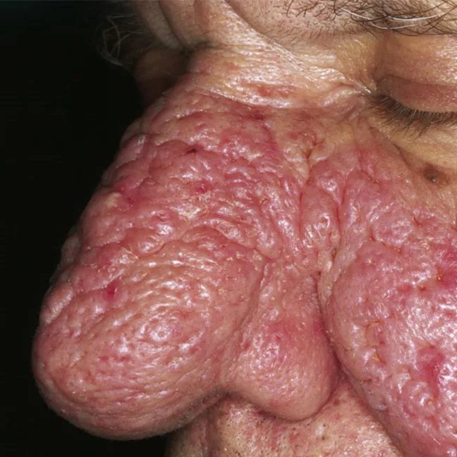 Rhinophyma: What It Is and How to Treat It