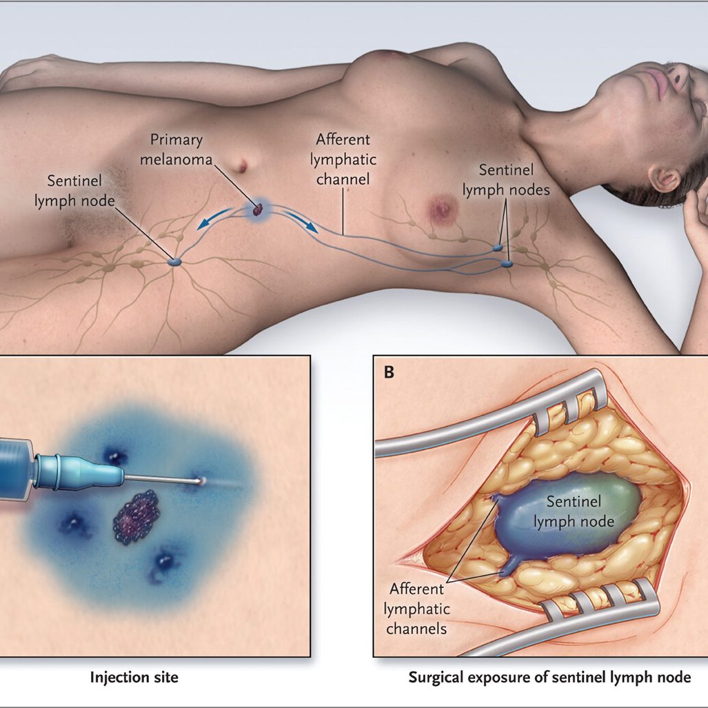 Cancer staging surgery Australia, Sentinel lymph node biopsy Gold Coast, Specialist plastic surgeon lymph node biopsy, Melanoma surgery sentinel node, merkel cancer surgery lymph node biopsy